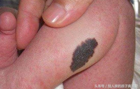 胎记算命图_算命胎记说明什么_算命算到了我的胎记