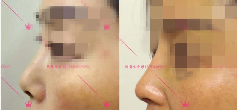 狮鼻男人命运_狮鼻面相女_狮鼻