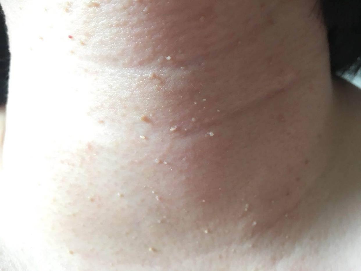脖子上的皮松弛是什么原因_脖子上有白色的一块怎么回事_脖子上的痣