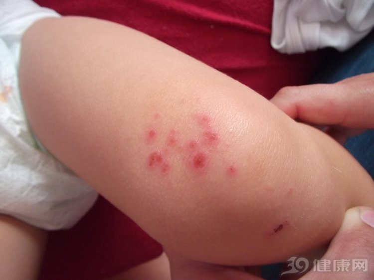 脖子上白斑是什么原因导致的_脖子上的皮松弛是什么原因_脖子上的痣