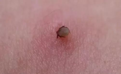 脖子上有白色的一块怎么回事_脖子上的痣_脖子上的皮松弛是什么原因